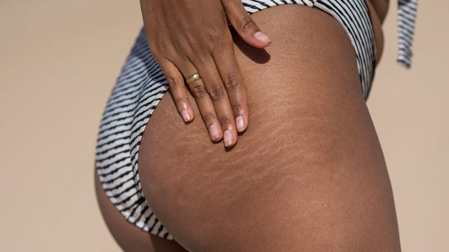Stressed About Stretch Marks? It's Time To Consider Dermarolling